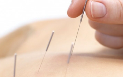 Tratamiento con Punción Seca